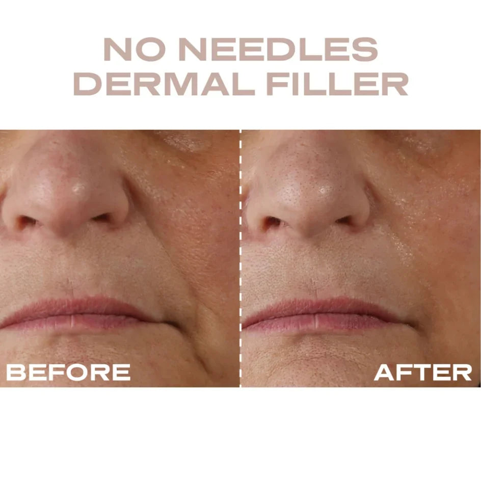 Plump It No Needles Derma Filler Pods Starter Kit 15 x 10ml